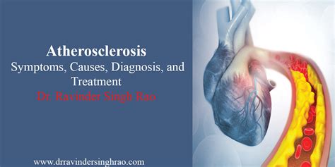 Atherosclerosis: Symptoms, Causes, Diagnosis, and Treatment.